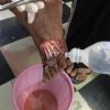 Donna di 74 anni con estesa lacerazione a lembo del dorso del piede causata da un tubo di scarico di acqua putrida prontamente operata dal nostro Chirurgo sul posto Annamaria