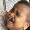 Bambino di un anno e mezzo affetto da labiopalatoschisi completa da operare.